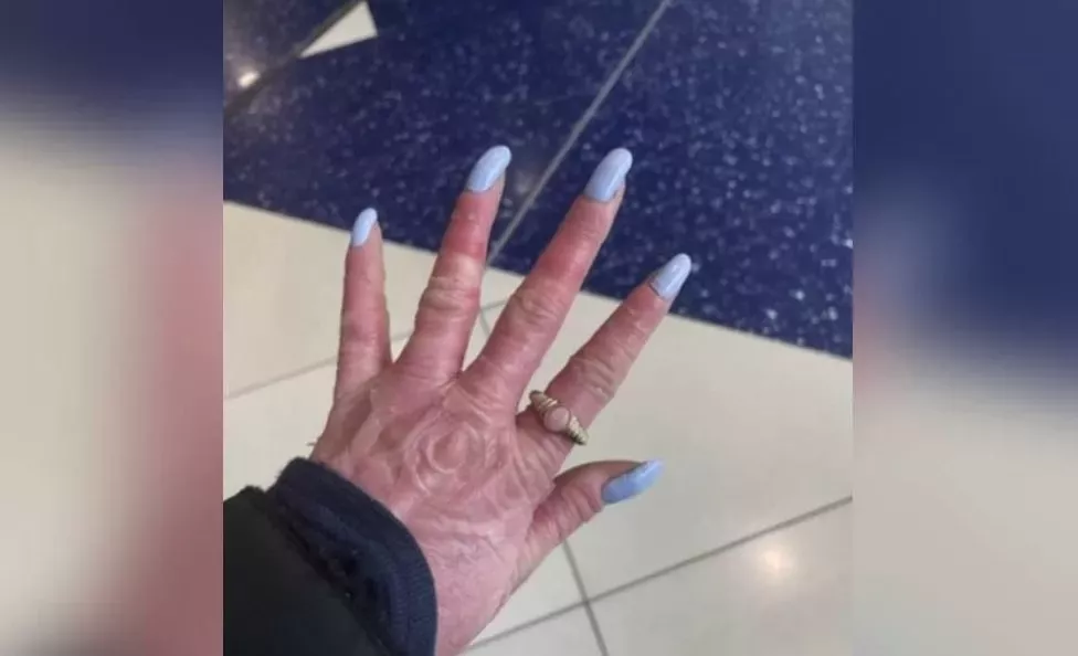 Rhiannon's nails are painted a pastel blue, and her hands are pink, red in some areas with scaling present.